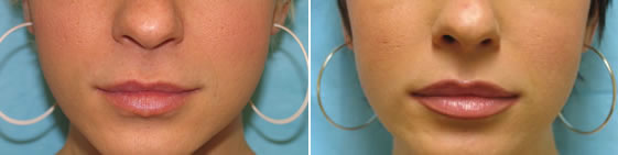 CaseStudies-Restylane