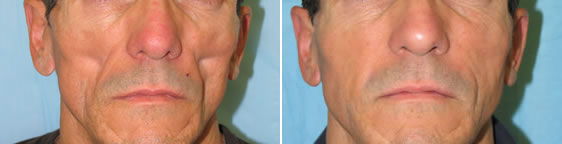 CaseStudies-Sculptra